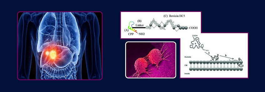 It took place for the first time in Iran: University of Tehran researchers have achieved a new method of treating liver cancer 