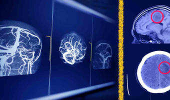 New Solution by University of Tehran Researchers to Enhance AI Security in Brain MRI Analysis
