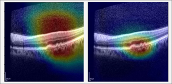 Réalisations des chercheurs de l'Université de Téhéran dans le domaine de la détection automatique des maladies oculaires